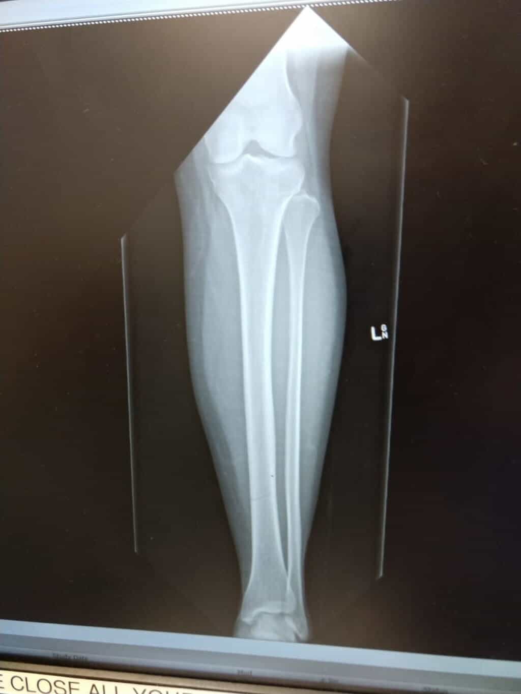 X-ray of the lower left leg